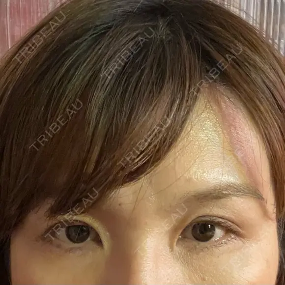 二重切開 / 上まぶたたるみ取り 心斎橋形成外科スキンケアクリニック AFTER メイン用