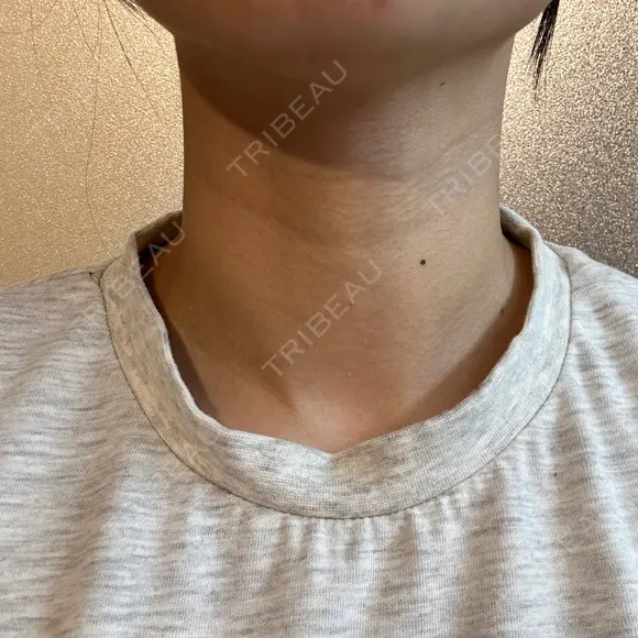 ハイフ（首） 湘南美容クリニック 新宿南口院 DAY 5 メイン用