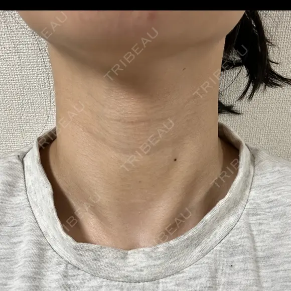 ハイフ（首） 湘南美容クリニック 新宿南口院 DAY 6 メイン用