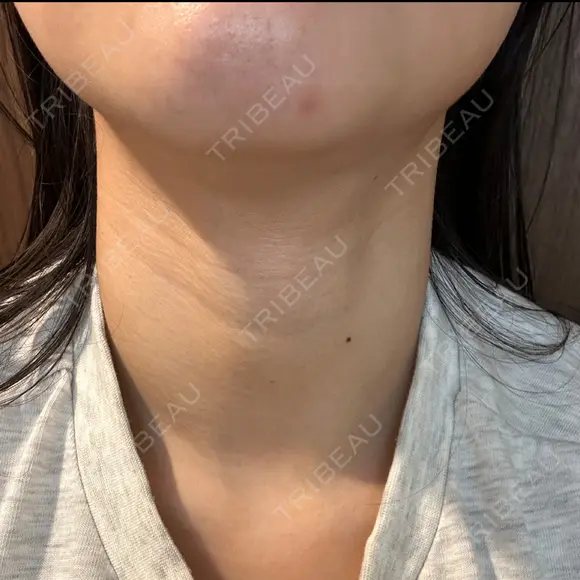 ハイフ（首） 湘南美容クリニック 新宿南口院 DAY 9 メイン用