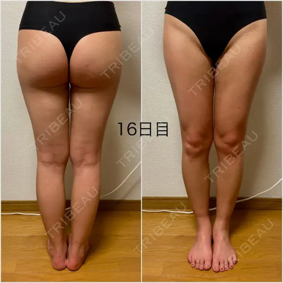 脂肪吸引（脚） / 豊胸（脂肪注入） GAYA body design clinic DAY 16 メイン用