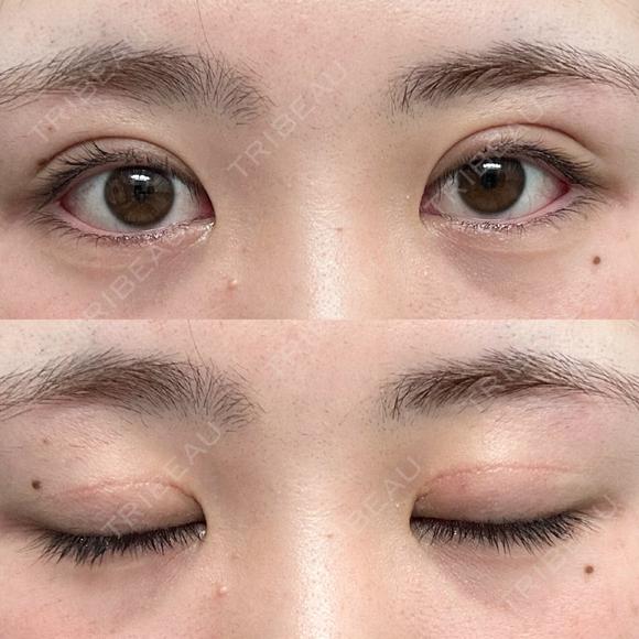 二重切開 つだ美容外科クリニック DAY 124 メイン用