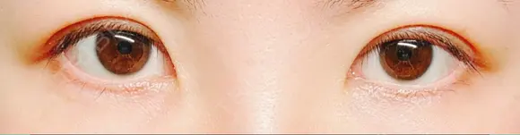 二重埋没 水の森美容クリニック 東京銀座院 DAY 14 メイン用