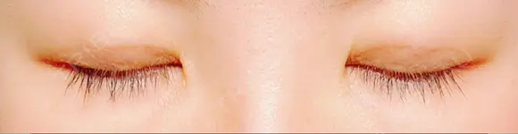 二重埋没 水の森美容クリニック 東京銀座院 DAY 14 メイン用