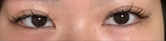 クマ治療 湘南美容クリニック 仙台院 DAY 19 メイン用