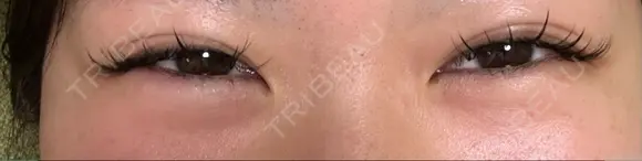 クマ治療 湘南美容クリニック 仙台院 DAY 19 メイン用