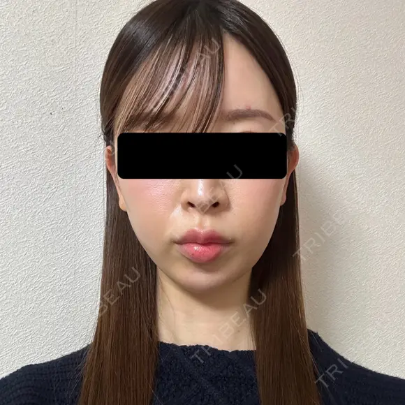 糸リフト / 脂肪吸引（顔） / ヒアルロン酸注入（あご） / ヒアルロン酸注入（こめかみ） BLINC CLINIC （ブリンク クリニック） AFTER メイン用