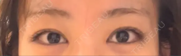 目頭切開 / 美容点滴・美容注射（疲労回復） HAAB×DREAM BEAUTY CLINIC 大阪梅田院 AFTER メイン用