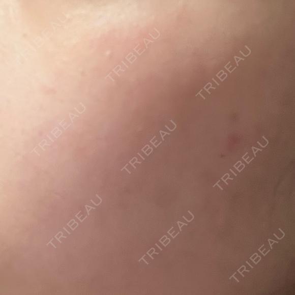 光治療（フォトフェイシャルなど） 美容皮膚科エルムクリニック 福岡院 AFTER メイン用