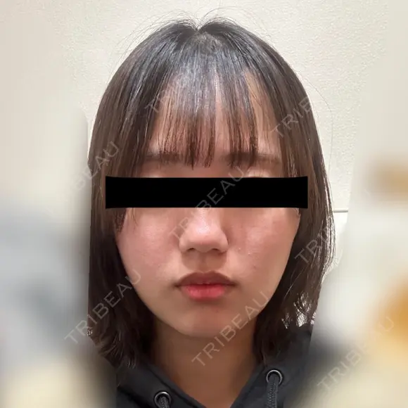 糸リフト / バッカルファット除去 SEA CLINIC（シークリニック） AFTER メイン用