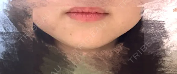 その他（肌） / ニードルRF（ポテンツァなど） KM新宿クリニック AFTER メイン用