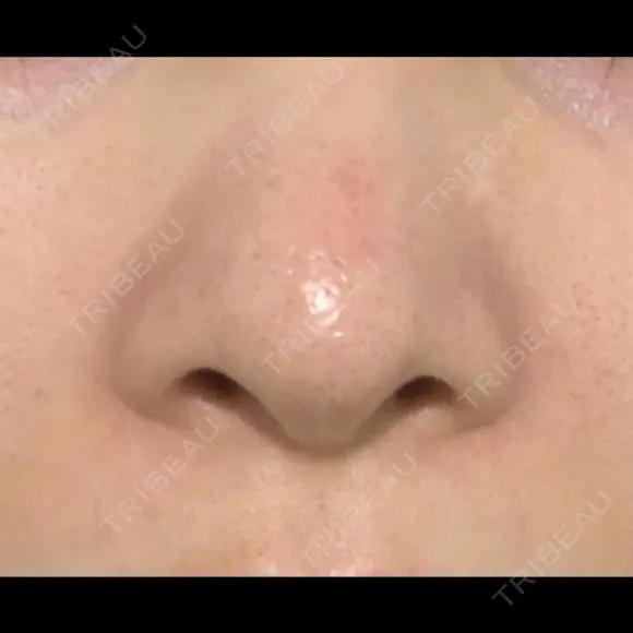 毛穴洗浄（ハイドラフェイシャルなど） 代官山ウィメンズクリニック DAY 2 メイン用