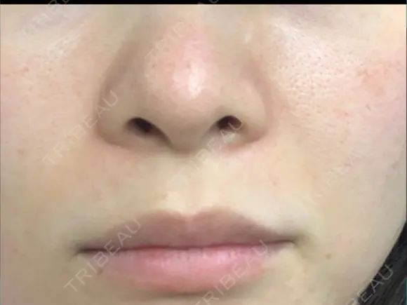 毛穴洗浄（ハイドラフェイシャルなど） 代官山ウィメンズクリニック DAY 3 メイン用