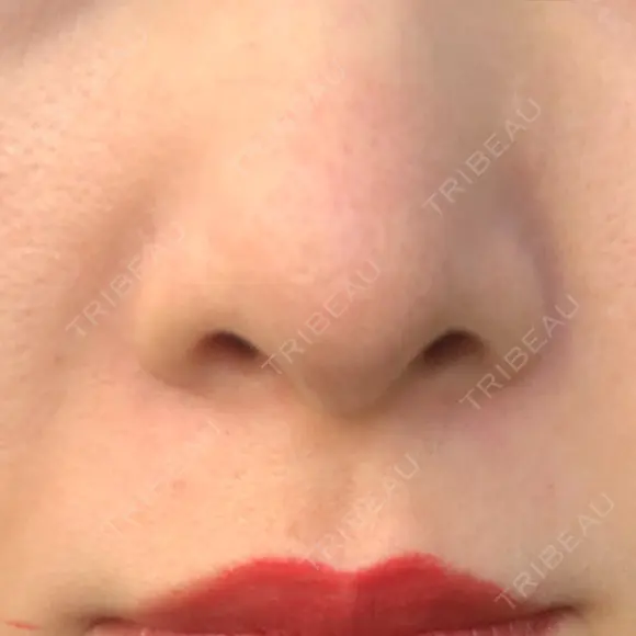 毛穴洗浄（ハイドラフェイシャルなど） 代官山ウィメンズクリニック DAY 4 メイン用