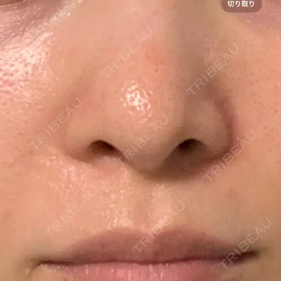 毛穴洗浄（ハイドラフェイシャルなど） 代官山ウィメンズクリニック DAY 6 メイン用