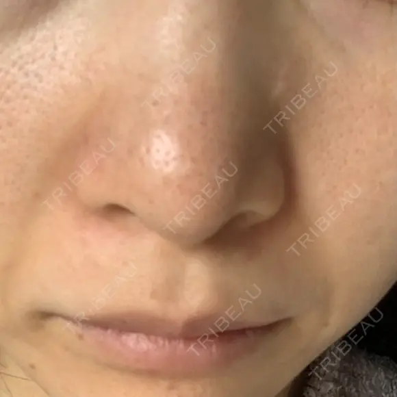 毛穴洗浄（ハイドラフェイシャルなど） 代官山ウィメンズクリニック DAY 8 メイン用