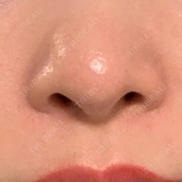 毛穴洗浄（ハイドラフェイシャルなど） 代官山ウィメンズクリニック DAY 9 メイン用