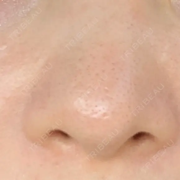 毛穴洗浄（ハイドラフェイシャルなど） 代官山ウィメンズクリニック AFTER メイン用