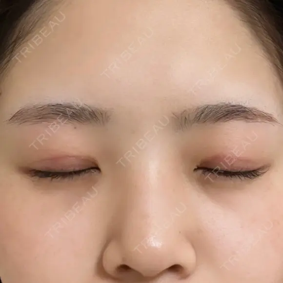 目頭切開 東京エビスクリニック DAY 72 メイン用