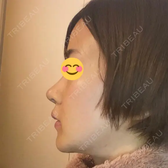 骨切り（あご） / 骨削り（エラ） / その他（輪郭） / セットバック アーククリニック AFTER メイン用