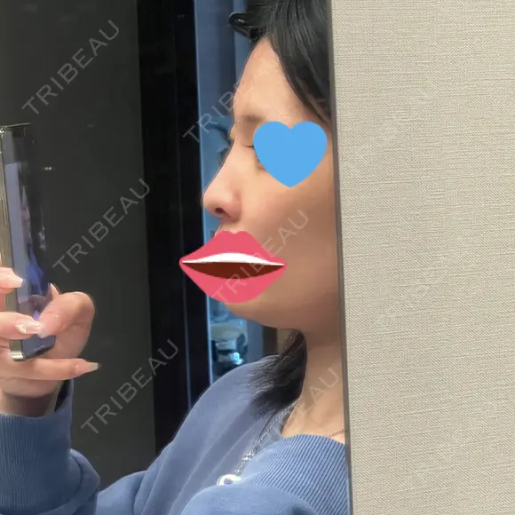 ヒアルロン酸注入（鼻） フィラークリニック 新宿院 DAY 0 メイン用