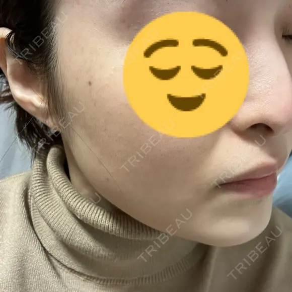 ピコスポット 日比谷セントラルクリニック AFTER メイン用