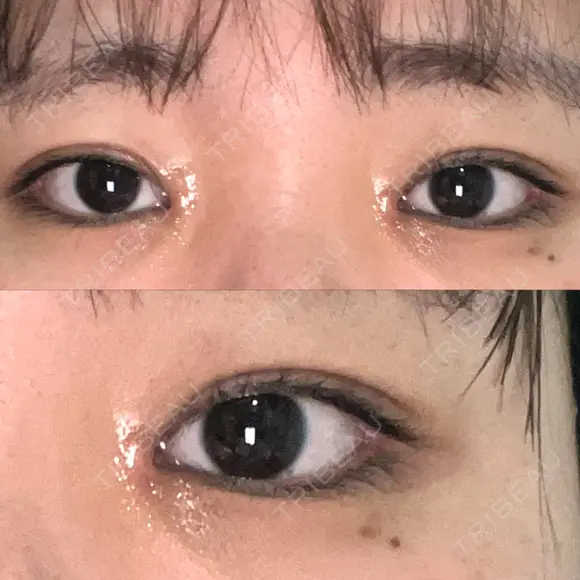 目頭切開 湘南美容クリニック 大阪心斎橋院 DAY 46 メイン用