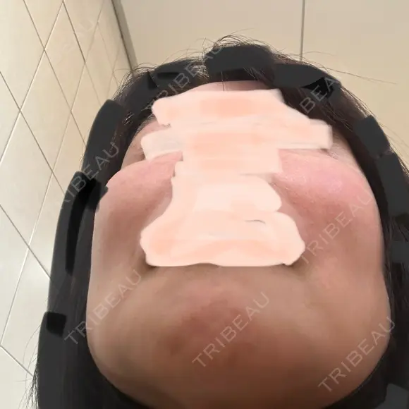 骨削り（エラ） / 骨削り（頬） ボンディ美容整形外科（旧リオン整形外科） AFTER メイン用