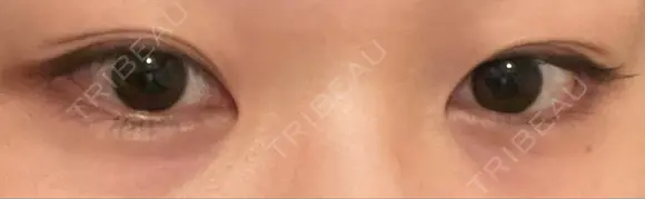 ヒアルロン酸注入（涙袋） KAGA CLINIC DAY 0 メイン用