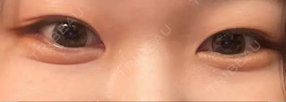 ヒアルロン酸注入（涙袋） KAGA CLINIC DAY 0 メイン用