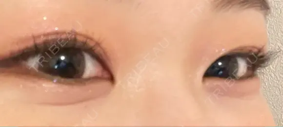 ヒアルロン酸注入（涙袋） KAGA CLINIC DAY 0 メイン用