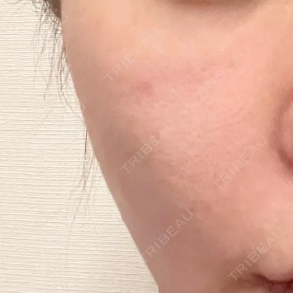 ヒアルロン酸注入（頬） oneUPclinic DAY 4 メイン用