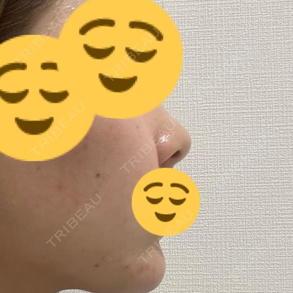 ハイフ（顔） / ピーリング（ニキビ・毛穴） / イオン導入 OMI CLINIC 【オミクリニック】 AFTER メイン用