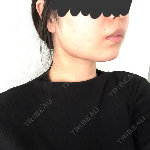 糸リフト / バッカルファット除去 / 脂肪吸引（顔） / メーラーファット除去 / 脂肪吸引注射（顔） SEA CLINIC（シークリニック） DAY 31 メイン用