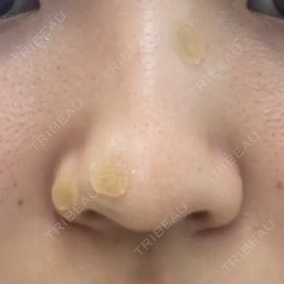 ほくろ・いぼ除去レーザー（肌） Fellez Clinic【フェルズクリニック】 DAY 0 メイン用