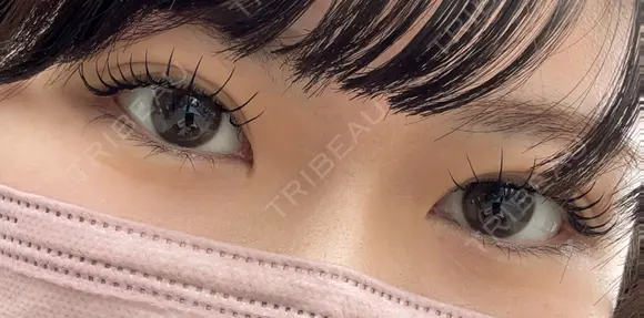 クマ治療 湘南美容クリニック 仙台院 DAY 9 メイン用