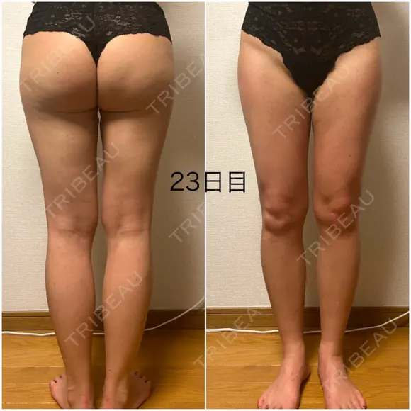 脂肪吸引（脚） / 豊胸（脂肪注入） GAYA body design clinic DAY 23 メイン用