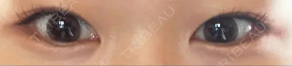 ヒアルロン酸注入（涙袋） KAGA CLINIC AFTER メイン用