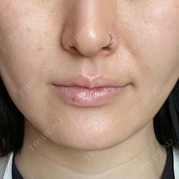 ヒアルロン酸注入（あご） 松倉クリニック 表参道 DAY 3 メイン用