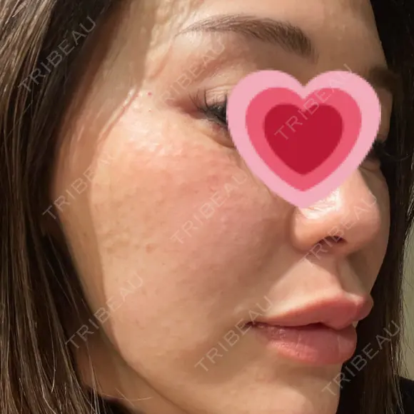 水光注射（ハリ・美肌） 赤羽ここちクリニック DAY 2 メイン用