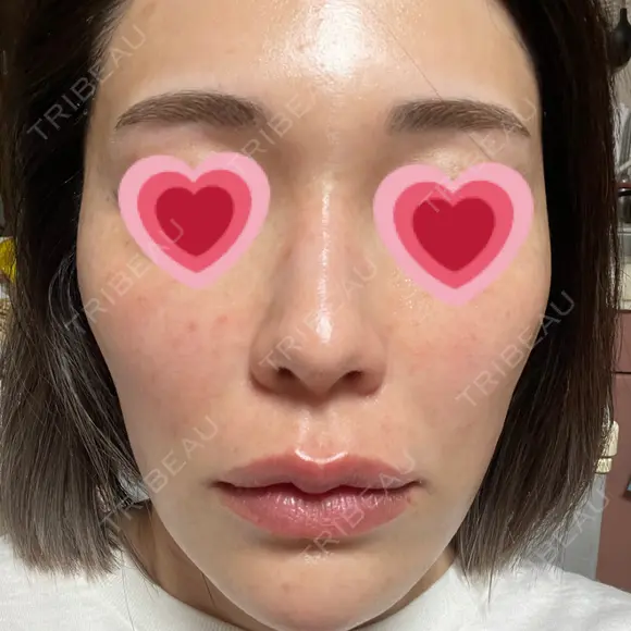 水光注射（ハリ・美肌） 赤羽ここちクリニック DAY 3 メイン用