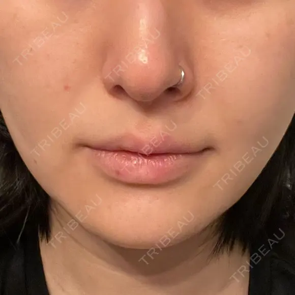 ヒアルロン酸注入（あご） 松倉クリニック 表参道 DAY 4 メイン用