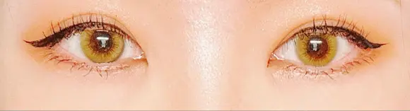 二重埋没 水の森美容クリニック 東京銀座院 DAY 22 メイン用