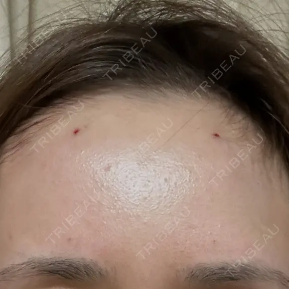 ヒアルロン酸注入（額） / ヒアルロン酸注入（こめかみ） LA CLEF CLINIC（ラクレクリニック） DAY 0 メイン用