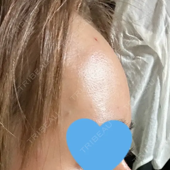 ヒアルロン酸注入（額） / ヒアルロン酸注入（こめかみ） LA CLEF CLINIC（ラクレクリニック） DAY 0 メイン用