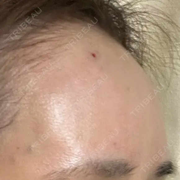 ヒアルロン酸注入（額） / ヒアルロン酸注入（こめかみ） LA CLEF CLINIC（ラクレクリニック） DAY 0 メイン用