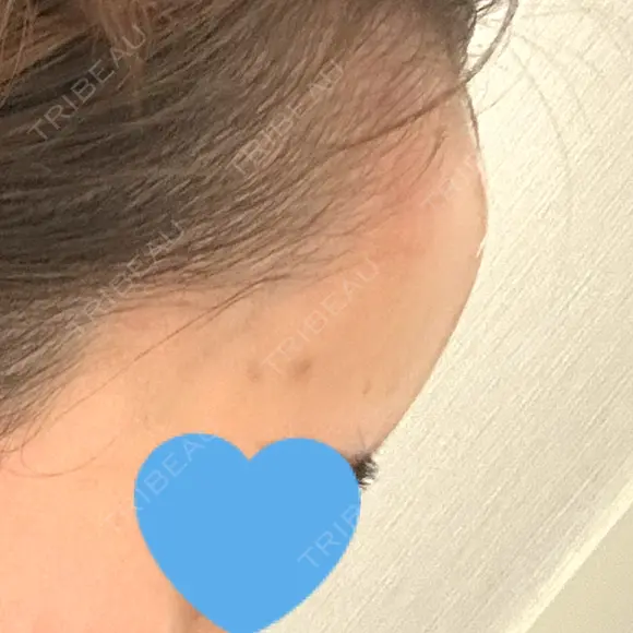 ヒアルロン酸注入（額） / ヒアルロン酸注入（こめかみ） LA CLEF CLINIC（ラクレクリニック） DAY 2 メイン用