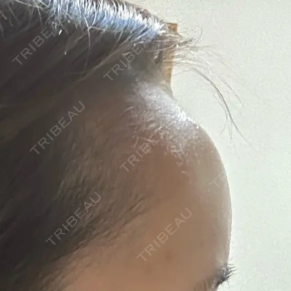 ヒアルロン酸注入（額） / ヒアルロン酸注入（こめかみ） LA CLEF CLINIC（ラクレクリニック） DAY 3 メイン用