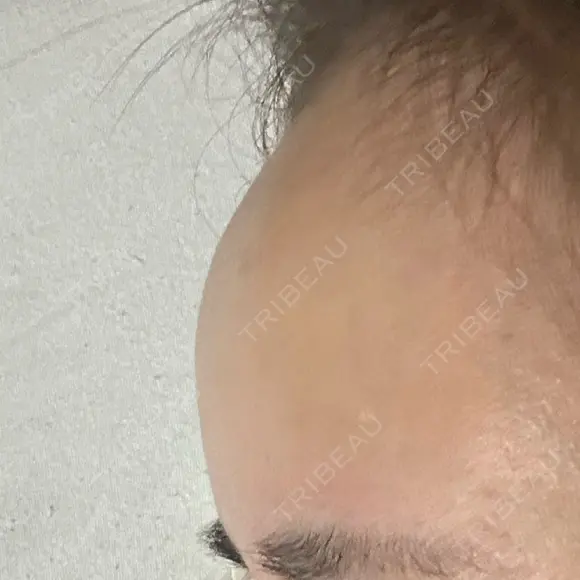 ヒアルロン酸注入（額） / ヒアルロン酸注入（こめかみ） LA CLEF CLINIC（ラクレクリニック） AFTER メイン用