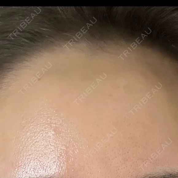 ヒアルロン酸注入（額） / ヒアルロン酸注入（こめかみ） LA CLEF CLINIC（ラクレクリニック） DAY 5 メイン用